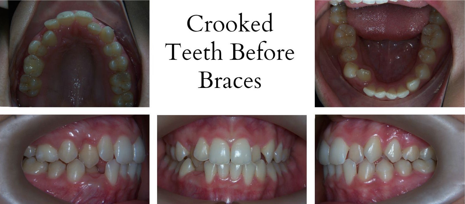 bad teeth before and after pictures
