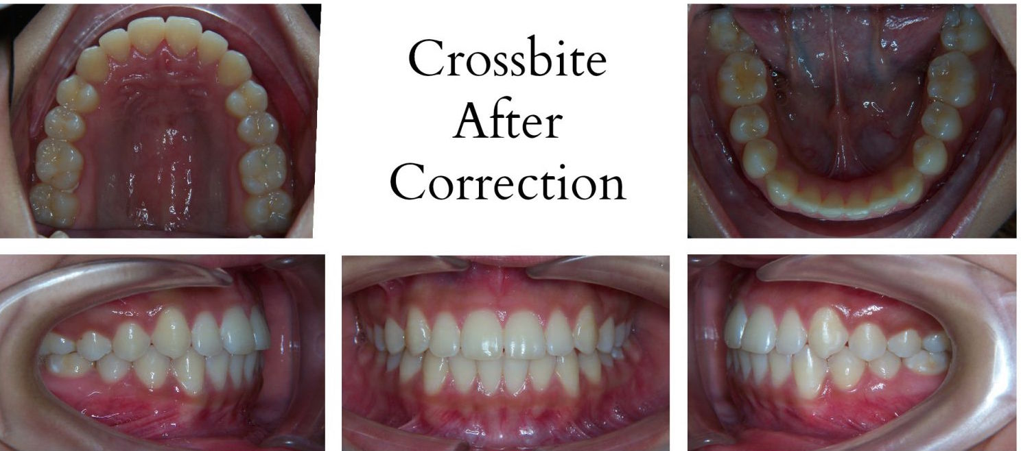 buck teeth before and after braces