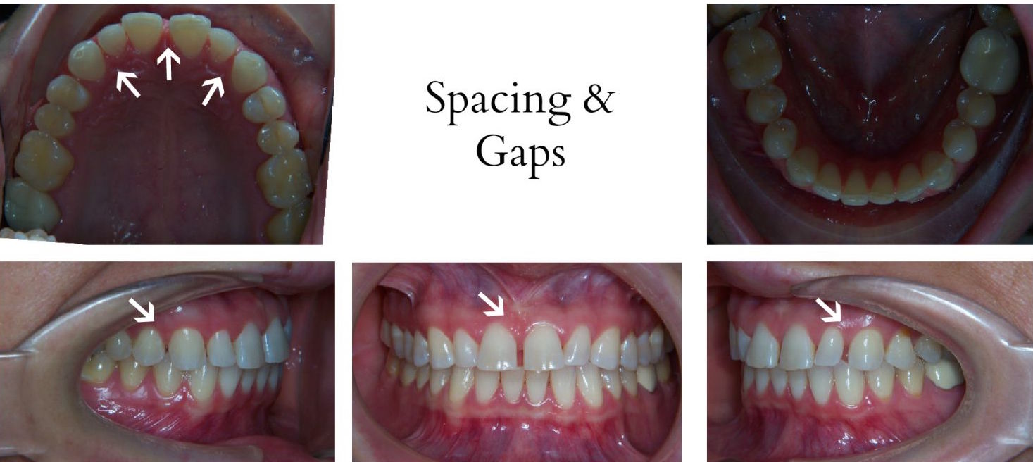 buck teeth before and after braces